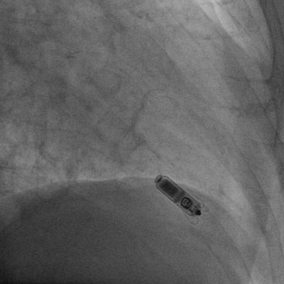 Fluoroscopy at the moment of Micra deployment — the device anchored in classic position at the right ventricular apex with delivery tether visible. Femoral venous approach. No chest incision required.