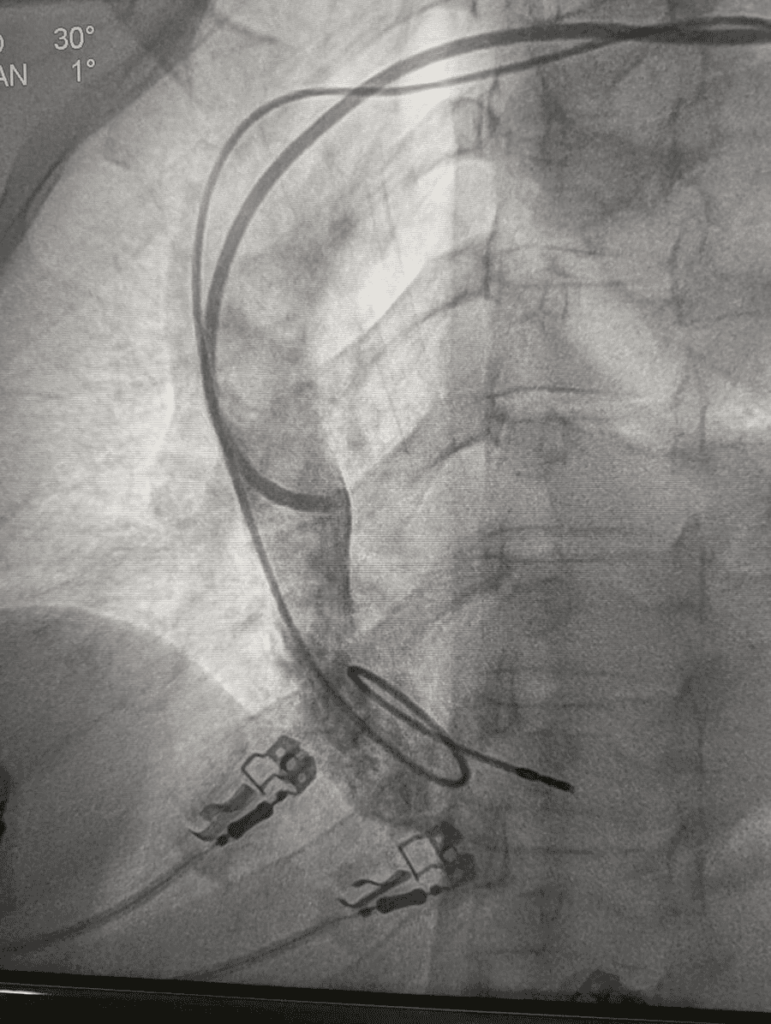 Bachmann bundle pacing