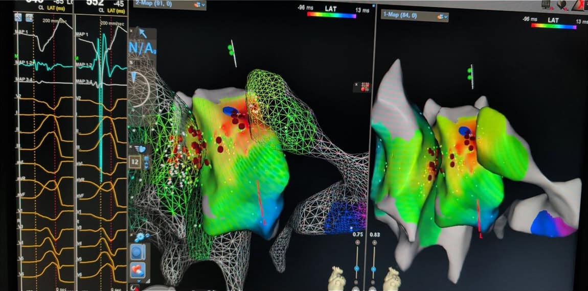 Composite-Carto-activation-map
