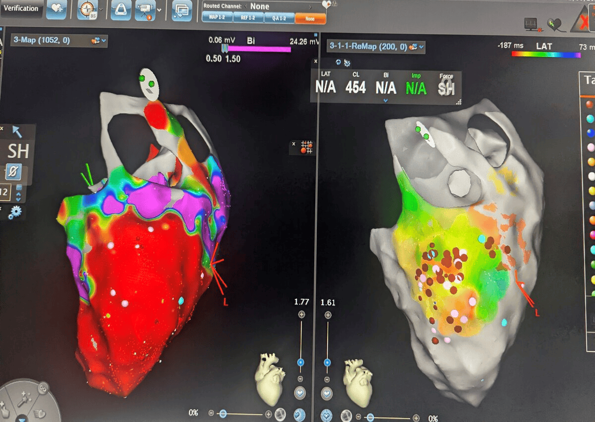 HCM VT