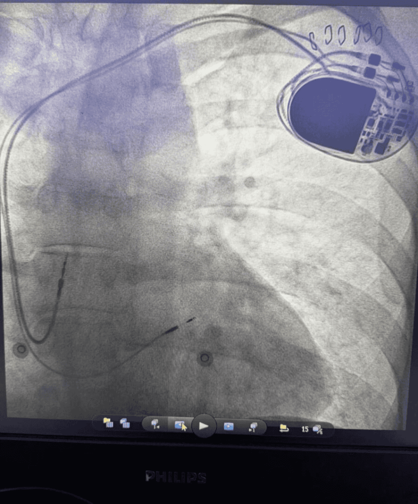 LBBAP fluoroscopy