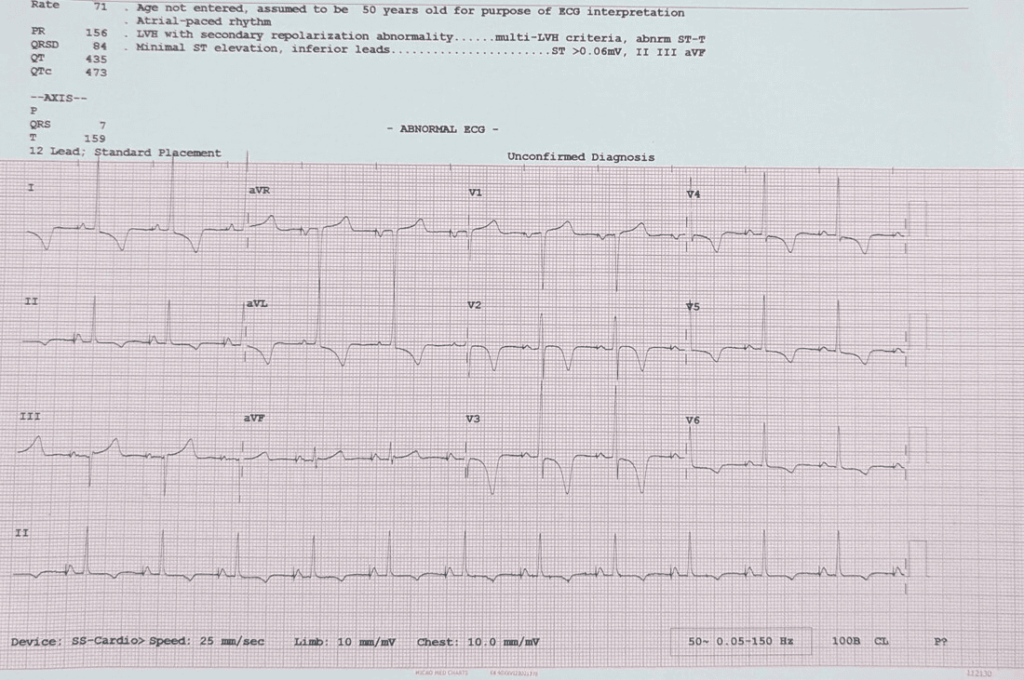 Post-BBP 12-lead ECG