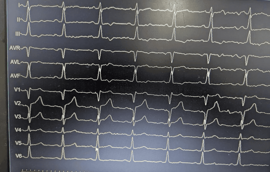 Post-LBBAP 12-lead ECG