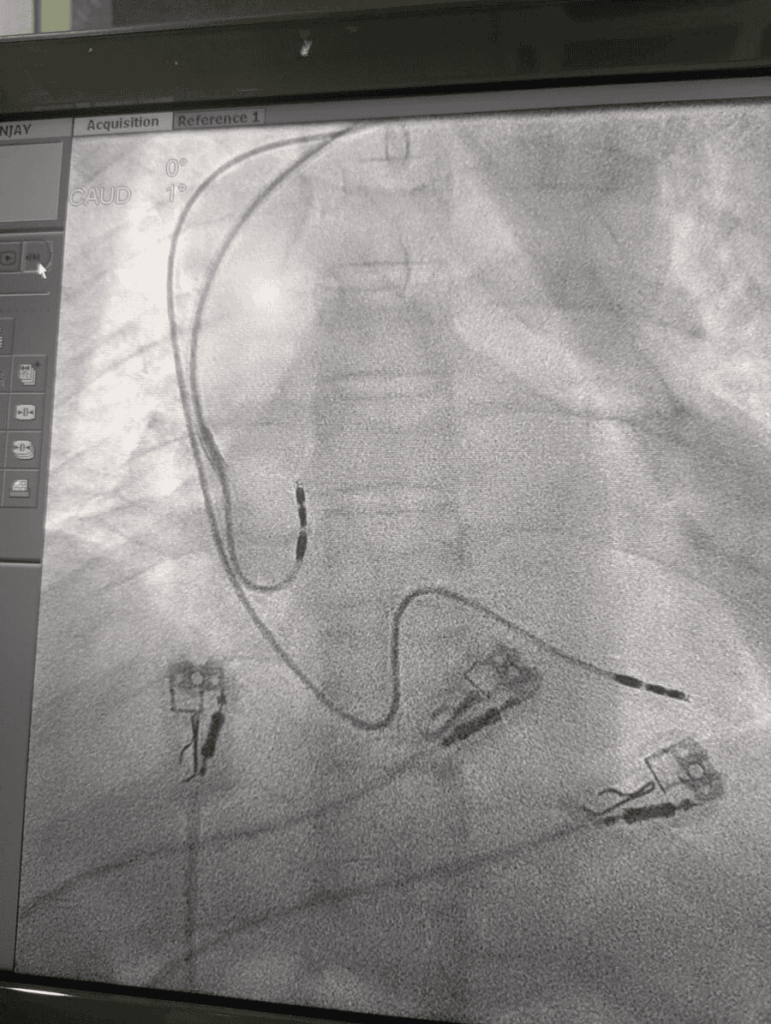 Second fluoroscopy