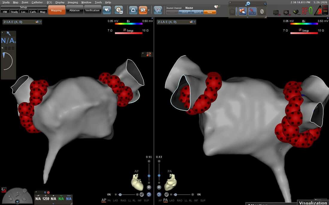 AP and PA views — same lesion set from anterior-posterior projections. PA view (right) confirms posterior wall between the pulmonary vein pairs. Four-projection complete.