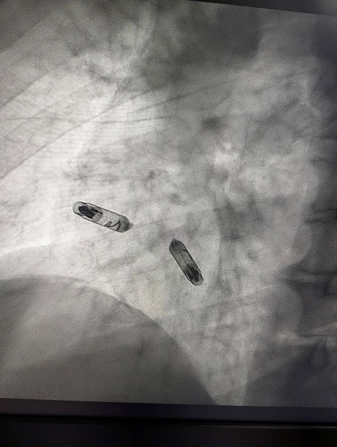 Final position — both Aveir DR components settled and deployed. Atrial device (upper left) and ventricular device (lower right) communicate wirelessly. No leads, no connections, no chest hardware