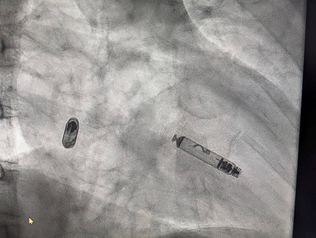 Fluoroscopy: Micra AV deployed at right ventricular apex with delivery tether visible. Femoral venous approach — no chest incision required. During deployment — atrial component visible in the right atrium (left), ventricular component in the right ventricle (right), both seen simultaneously on fluoroscopy