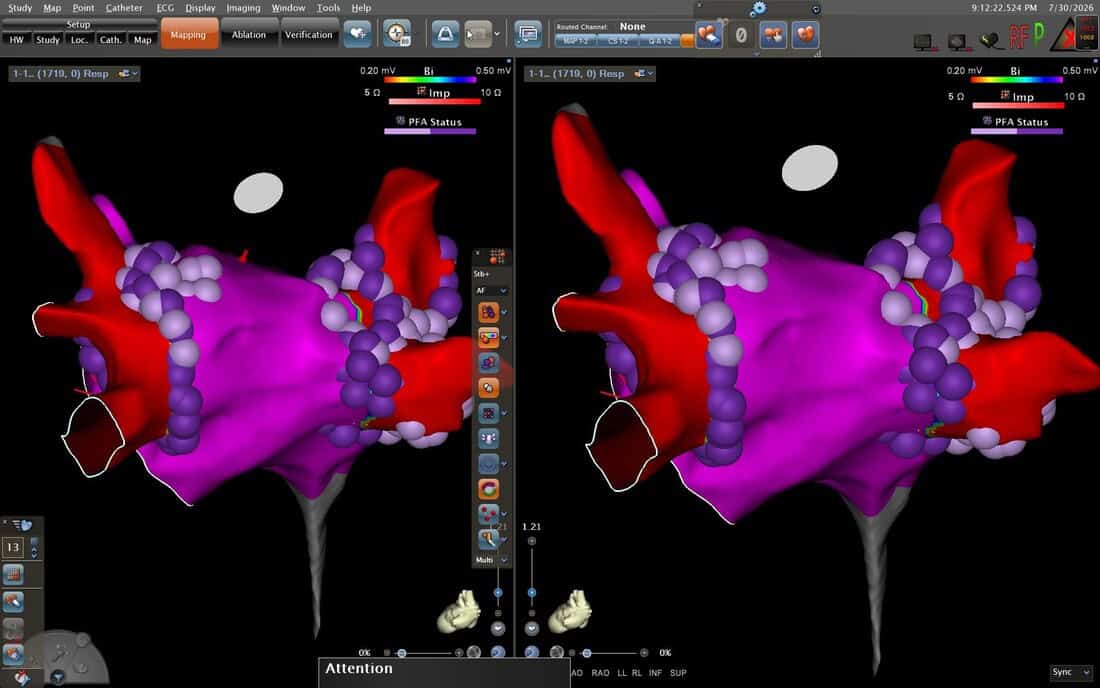 Post-PFA — Varipulse lesion set on Carto 3. Dense purple spherical tags showing circumferential PFA deliveries around all four pulmonary veins — complete pulmonary vein isolation.