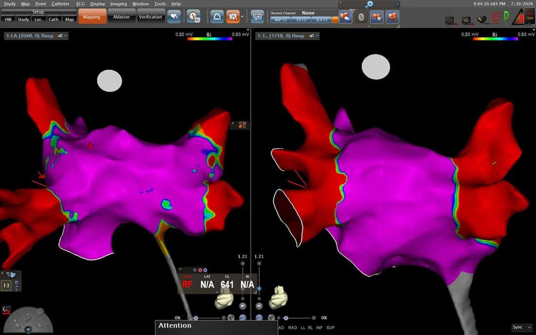 Pre-ablation — high-density Carto 3 activation map (2340 points). Left atrium in magenta, pulmonary veins in red. AF cycle length 641ms. Substrate defined before PFA delivery.