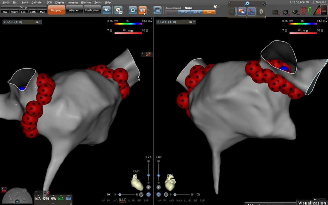 RAO and LAO views — vHPSD QDot lesion set encircling all four pulmonary veins. Continuous red VisiTag spheres confirm complete circumferential isolation on both projections.